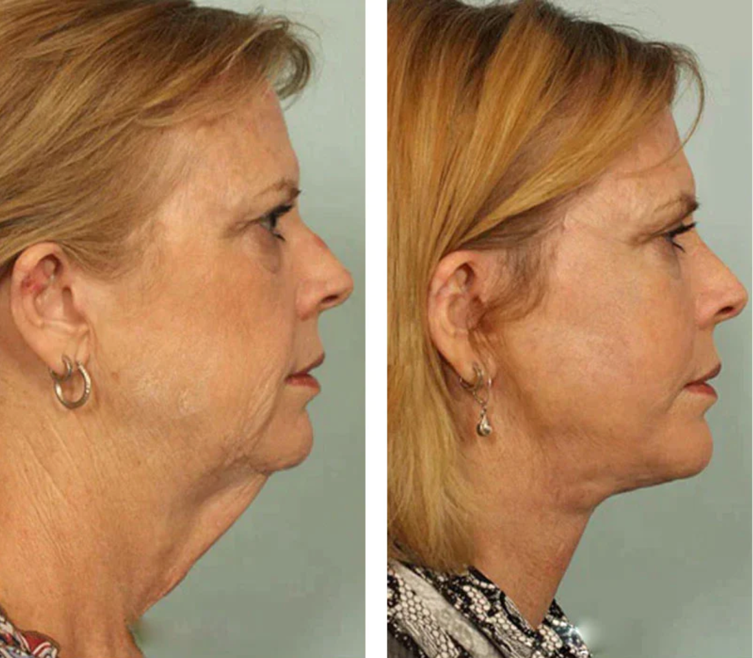 Sleepiz® | 3 in 1 device to eliminate wrinkles, neck fat and tighten the skin
